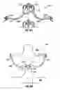Fig. 25 - Expandable device for use in a well bore