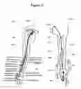 Fig. 02 - Implantable device and method for treatment of hypertension