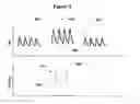 Fig. 09 - Implantable device and method for treatment of hypertension