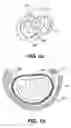 Fig. 02 - Devices and methods for heart valve treatment
