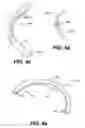 Fig. 06 - Devices and methods for heart valve treatment
