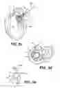 Fig. 09 - Devices and methods for heart valve treatment