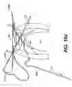 Fig. 33 - Devices and methods for heart valve treatment