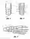 Fig. 02 - Subtalar implant