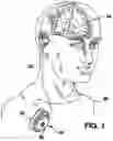 Fig. 02 - Method of controlling an implantable medical device with optimized pump drive