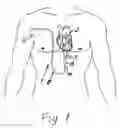 Fig. 02 - Pacemaker electrode array