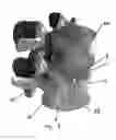 Fig. 07 - Intervertebral disc prosthesis