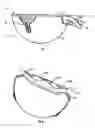Fig. 02 - Prosthesis