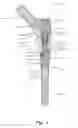 Fig. 02 - Welded hip prosthesis