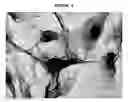 Fig. 07 - Human malignant cystosarcoma phyllodes derived mouse cell line