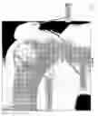 Fig. 22 - Methods and apparatus for conformable prosthetic implants
