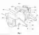 Fig. 02 - Interspinous process implant including a binder and method of implantation