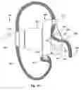 Fig. 09 - Interspinous process implant including a binder and method of implantation