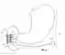 Fig. 07 - Radially expandable gastrointestinal stimulation device
