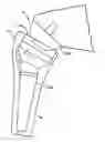 Fig. 01 - Extended articulation prosthesis adaptor and associated method
