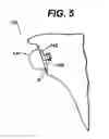 Fig. 06 - Extended articulation prosthesis adaptor and associated method