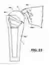 Fig. 22 - Extended articulation prosthesis adaptor and associated method