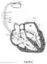 Fig. 06 - Arrhythmia classification and therapy selection