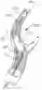 Fig. 01 - Method of performing protected angioplasty and stenting at a carotid bifurcation