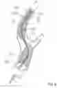 Fig. 09 - Method of performing protected angioplasty and stenting at a carotid bifurcation