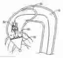 Fig. 01 - Method and apparatus for percutaneous valve repair