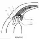 Fig. 06 - Intraocular device for the restoring visual accommodation of presbiopic eye