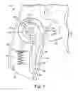 Fig. 18 - Transurethral needle ablation system with flexible catheter tip