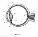 Fig. 02 - Shunt device and method for treating glaucoma