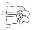 Fig. 01 - Devices and methods for the treatment of spinal disorders