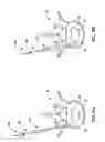 Fig. 16 - Devices and methods for the treatment of spinal disorders