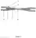 Fig. 13 - Devices and methods for interlocking surgical screws and nails