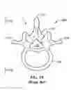 Fig. 02 - Internal fixation system for spine surgery