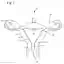 Fig. 02 - Method and apparatus for treating abnormal uterine bleeding