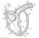 Fig. 01 - Delivery system and method using pulmonary artery for placement of RV leads