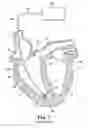 Fig. 02 - Delivery system and method using pulmonary artery for placement of RV leads