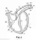 Fig. 03 - Delivery system and method using pulmonary artery for placement of RV leads