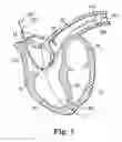 Fig. 04 - Delivery system and method using pulmonary artery for placement of RV leads