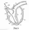Fig. 06 - Delivery system and method using pulmonary artery for placement of RV leads