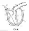 Fig. 07 - Delivery system and method using pulmonary artery for placement of RV leads