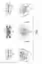Fig. 02 - Intervertebral implant and rachis stabilization device