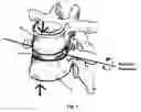 Fig. 02 - Dynamic spinal implant or joint replacement