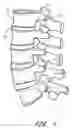 Fig. 02 - Method of spinal fixation using adhesive media