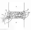 Fig. 01 - Methods for explantation of intervertebral disc implants