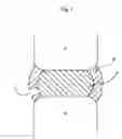 Fig. 02 - Methods for explantation of intervertebral disc implants