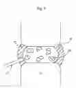 Fig. 06 - Methods for explantation of intervertebral disc implants