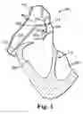 Fig. 06 - System and method for catheter-based septal defect repair