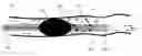 Fig. 01 - Fluid occluding devices and methods