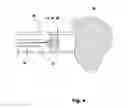 Fig. 05 - Ebolic apparatus and methods for tumor vasculture system obstruction