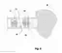 Fig. 06 - Ebolic apparatus and methods for tumor vasculture system obstruction