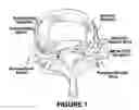 Fig. 02 - Injection of fibrin sealant using reconstituted components in spinal applications